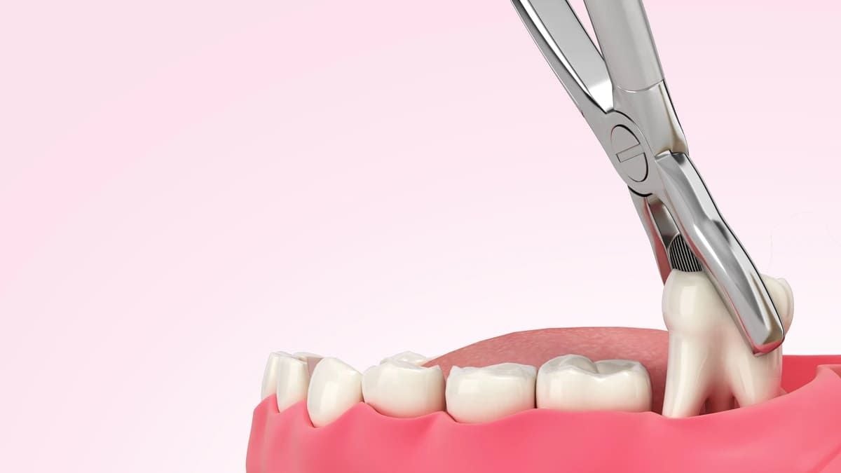 The Imperative of Wisdom Teeth Extraction: A Journey Towards Oral Health