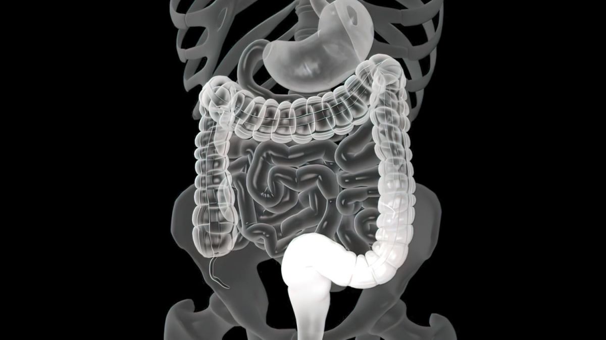 Earliest Signs of Colorectal cancer