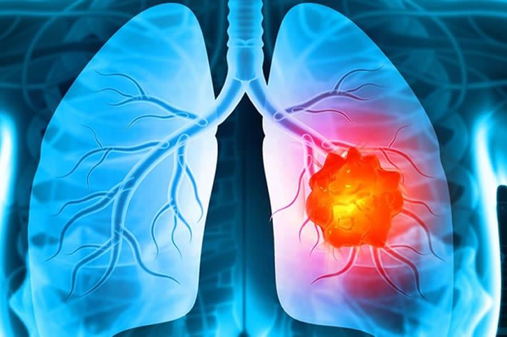 Guide to Understanding Lung Cancer