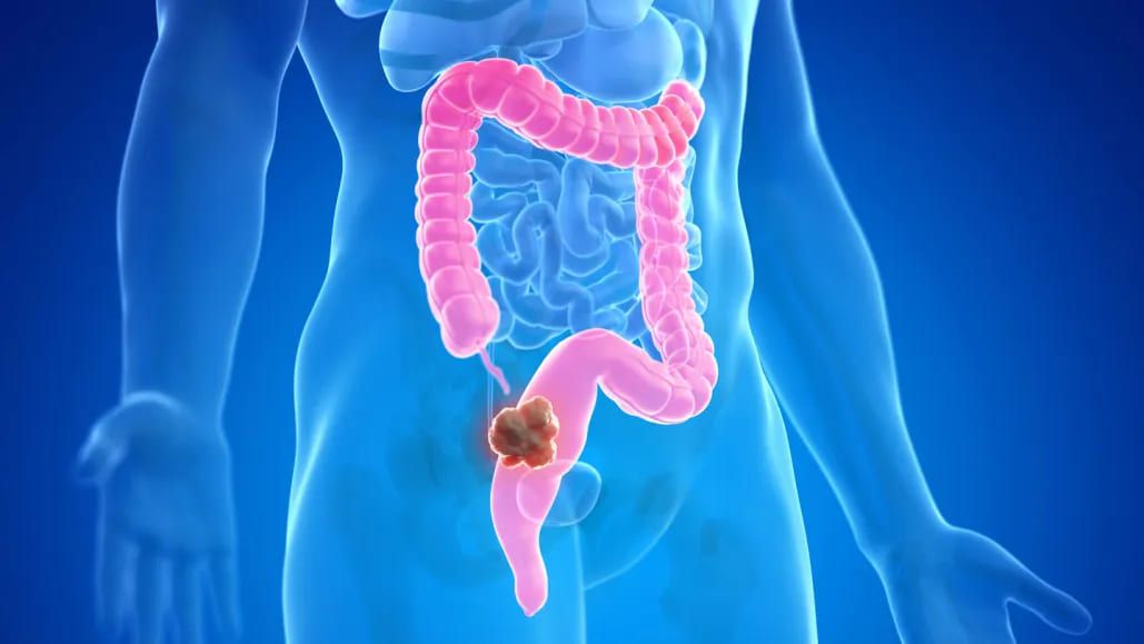 Colorectal Cancer: What to Look Out For