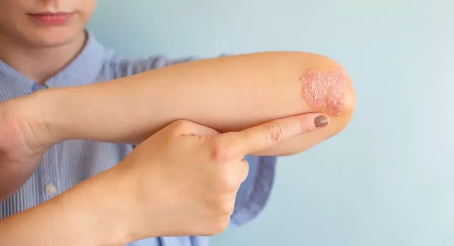 Symptoms of Plaque Psoriasis