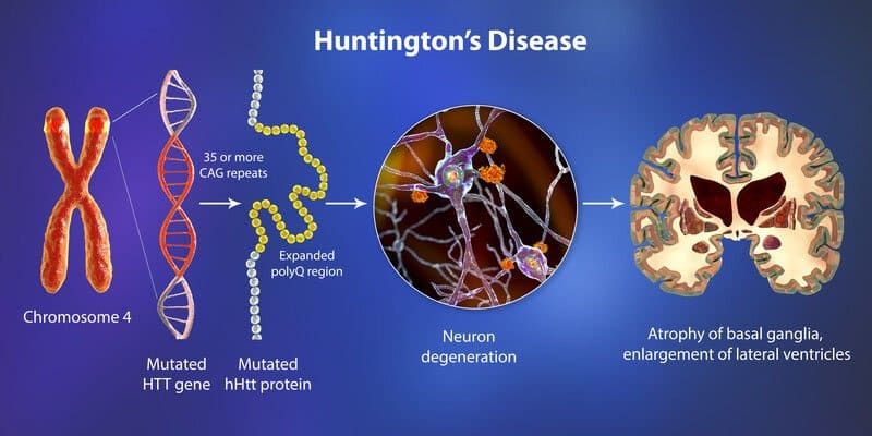 Everything you should know about Huntington’s Disease