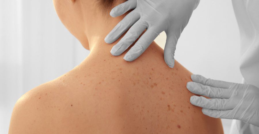 Unmasking Skin Cancer: The Silent Epidemic