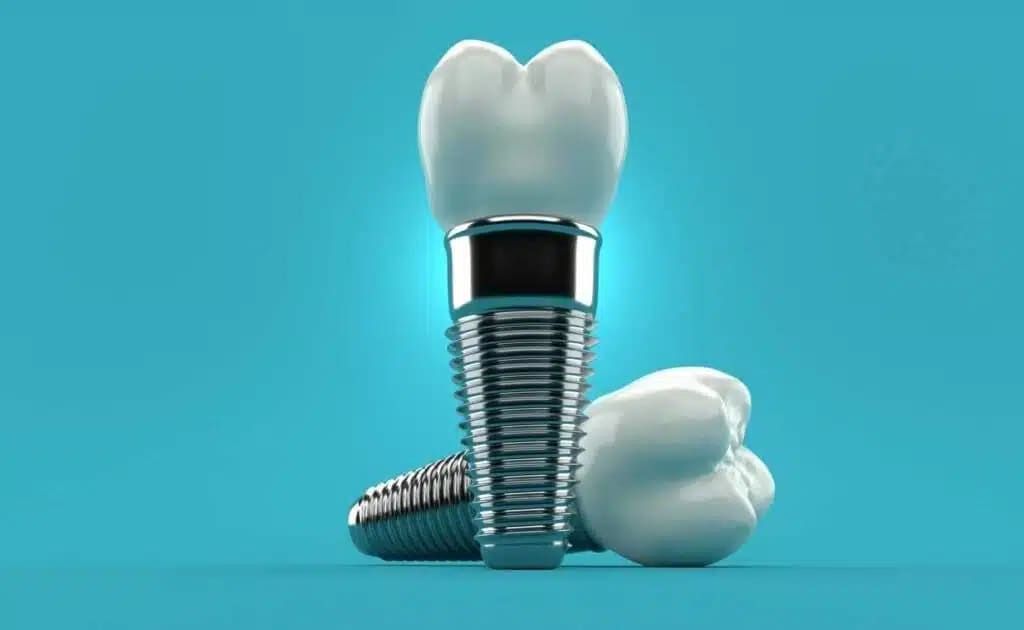 O Mundo dos Implantes Dentários: Um Guia Multifacetado